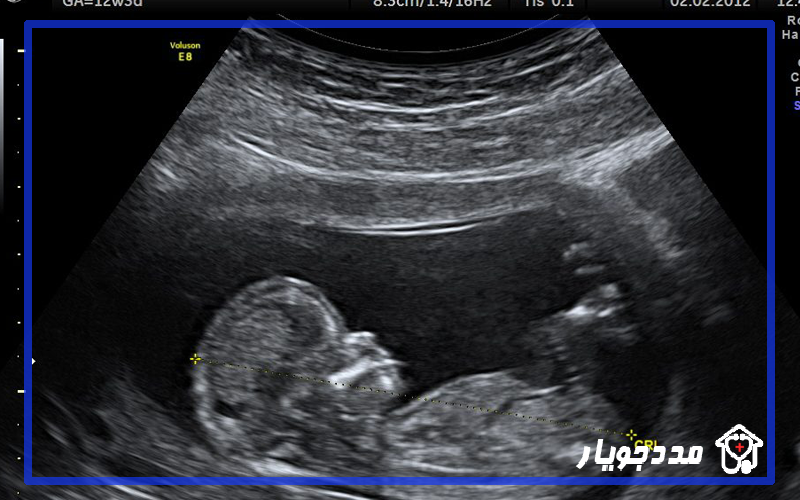 s/سونو سه ماهه سوم بارداری